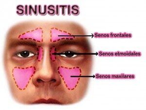 sinusitis-300x227-7348538